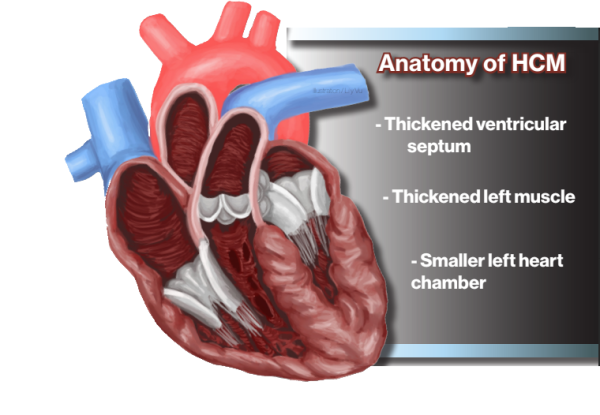 Freshman project treats chronic heart condition
